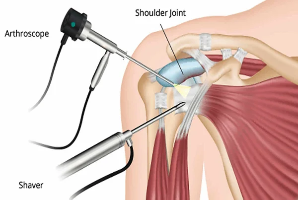 Shoulder Replacement Surgery
